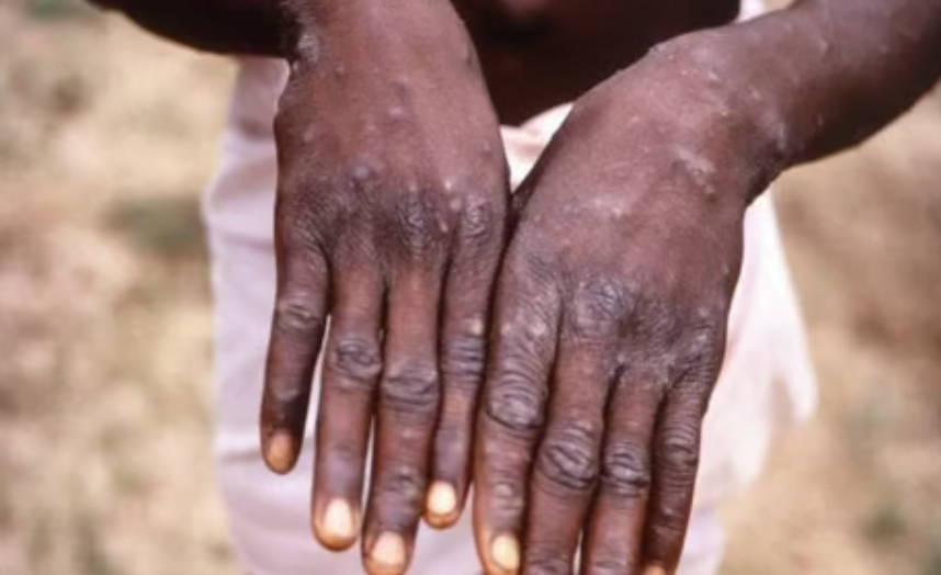 Screenshot 2024-08-28 162243 Mpox Outbreak Africa - WHO to Announce This Week Whether Mpox Outbreak in Africa is a Global Emergency